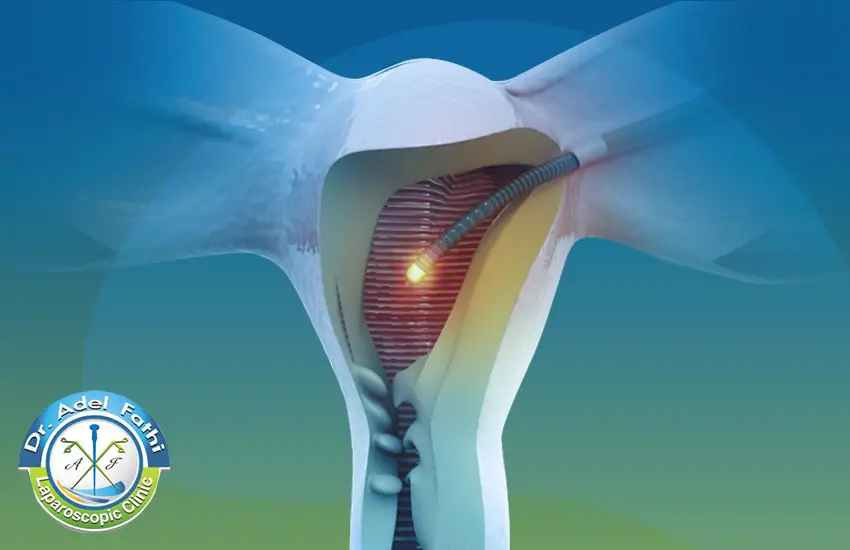 عملية استئصال الرحم بالمنظار