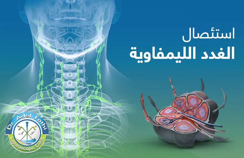 استئصال الغدد الليمفاوية - الدكتور عادل فتحي