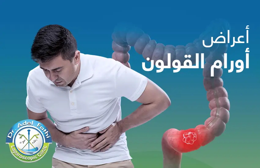 اعراض-اورام-القولون أعراض اورام القولون