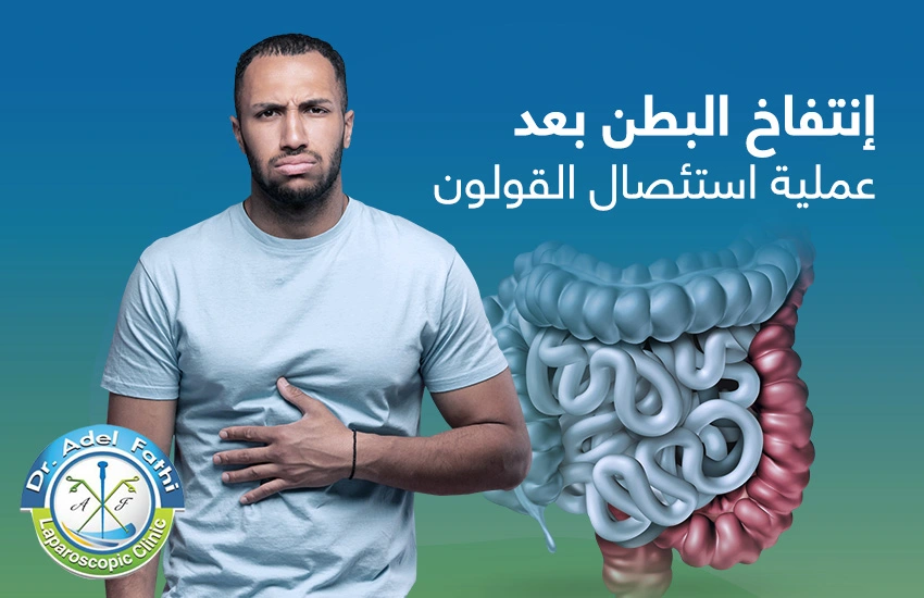 انتفاخ-البطن-بعد-عملية-استئصال-القولون انتفاخ البطن بعد عملية استئصال القولون