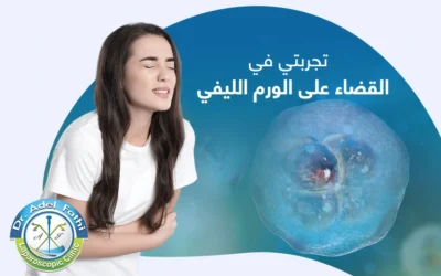 تجربتي في القضاء على الورم الليفي