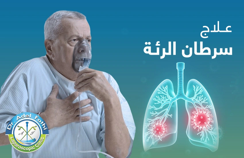 علاج سرطان الرئة