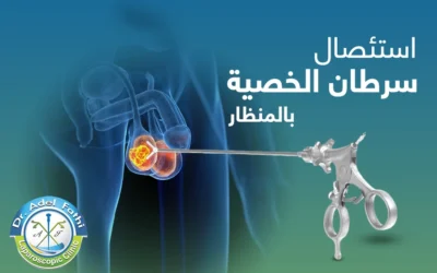 استئصال سرطان الخصية بالمنظار | التقنية الحديثة في العلاج