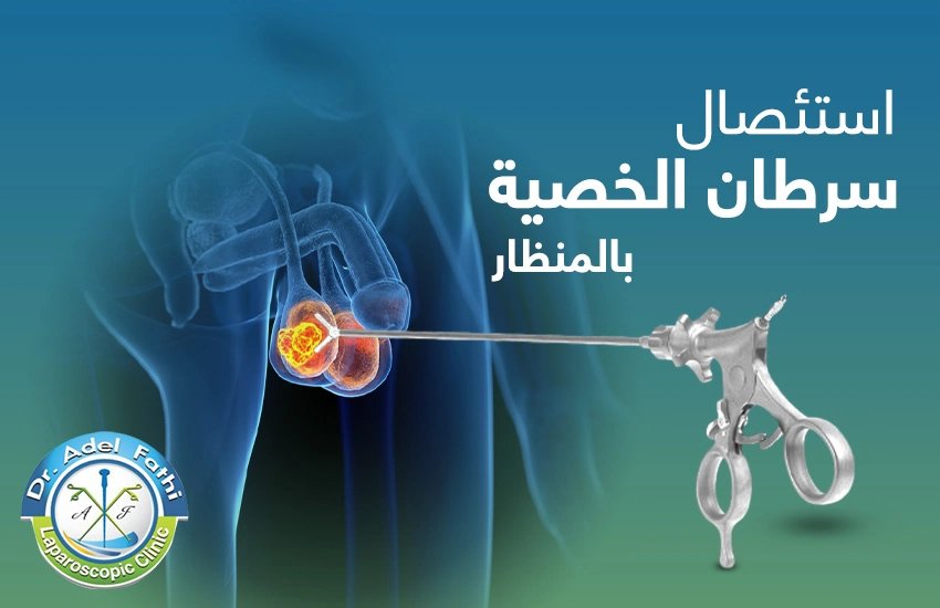 استئصال-سرطان-الخصية-بالمنظار استئصال سرطان الخصية بالمنظار
