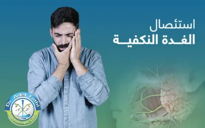 استئصال الغدة النكفية
