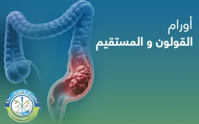 ما أسباب الإصابة بأورام القولون والمستقيم؟