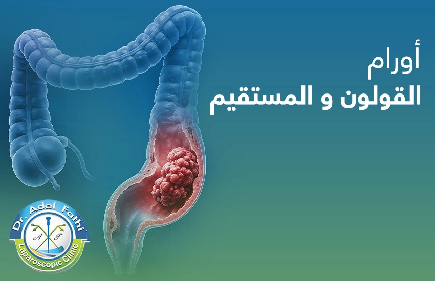 أورام-القولون-و-المستقيم أورام القولون والمستقيم
