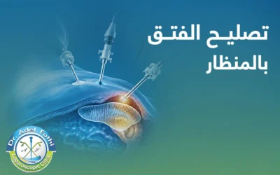 متى تحتاج إلى تصليح الفتق بالمنظار؟ وأهم التعليمات بعد العملية
