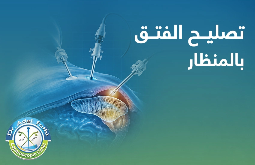 تصليح الفتق بالمنظار