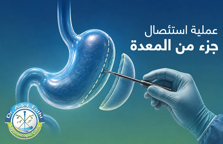 عملية استئصال جزء من المعدة